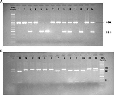 The role of ACE1 I/D and ACE2 polymorphism in the outcome of Iranian COVID-19 patients: A case-control study